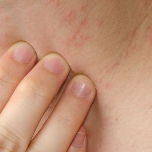 brufoli sul collo e sotto le orecchie